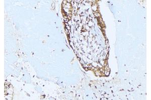 ABIN6275353 at 1/100 staining Human lung cancer tissue by IHC-P. (PEX10 Antikörper  (Internal Region))