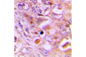 Immunohistochemical analysis of RPL18 staining in human lung cancer formalin fixed paraffin embedded tissue section. (RPL18 Antikörper  (Center))