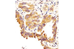Antibody staining SFTPC in human lung adenocarcinoma sections by Immunohistochemistry (IHC-P - paraformaldehyde-fixed, paraffin-embedded sections). (Surfactant Protein C Antikörper  (C-Term))