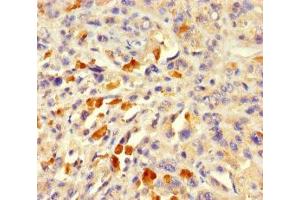 Immunohistochemistry of paraffin-embedded human melanoma using ABIN7143055 at dilution of 1:100 (Actin-Like 7A Antikörper  (AA 1-435))