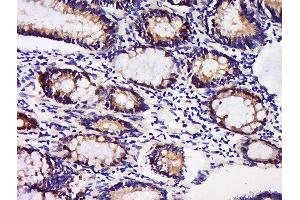 Formalin-fixed and paraffin embedded human colon carcinoma labeled with Anti-GDNFRA Polyclonal Antibody, Unconjugated  at 1:200 followed by conjugation to the secondary antibody and DAB staining. (GFRA1 Antikörper  (AA 351-429))