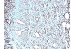 Formalin-fixed, paraffin-embedded human Colon stained with Cadherin 17 / CDH17 Mouse Monoclonal Antibody (CDH17/2617). (LI Cadherin Antikörper  (AA 242-418))