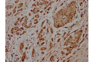 IHC image of ABIN7164633 diluted at 1:100 and staining in paraffin-embedded human pancreatic cancer performed on a Leica BondTM system. (PCOLCE Antikörper  (AA 169-449))