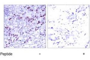 Immunohistochemical analysis of paraffin-embedded human breast carcinoma tissue using GATA1 polyclonal antibody . (GATA1 Antikörper  (Ser142))
