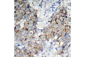 Immunohistochemistry of paraffin-embedded human breast carcinoma using Phospho-IGF1R-Y1161 antibody (ABIN2988064). (IGF1R Antikörper  (pTyr1161))