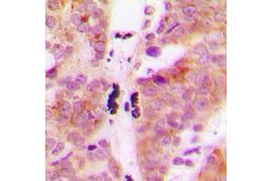 Immunohistochemical analysis of KLHL29 staining in human breast cancer formalin fixed paraffin embedded tissue section. (KLHL29 Antikörper  (Center))