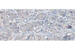 Immunohistochemistry of paraffin-embedded Human breast cancer tissue using RASA1 Polyclonal Antibody at dilution of 1:40(x200)
