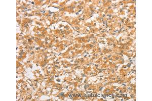 Immunohistochemistry of Human gastric cancer using TLR3 Polyclonal Antibody at dilution of 1:50 (TLR3 Antikörper)