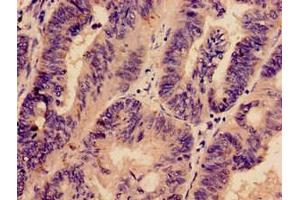 Immunohistochemistry analysis of human colon cancer using ABIN7163177 at dilution of 1:100 (PREX1 Antikörper  (AA 1-44))