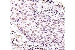 Immunohistochemistry of paraffin embedded human breast cancer using ZKSCAN4 (ABIN7076265) at dilution of 1:400 (400x lens) (ZKSCAN4 Antikörper)