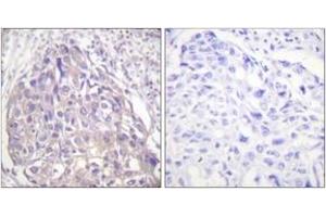 Immunohistochemistry analysis of paraffin-embedded human breast carcinoma, using FOXO1/3/4-pan (Phospho-Thr24/32) Antibody. (FOXO1 Antikörper  (pThr24))