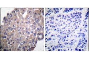 Immunohistochemistry analysis of paraffin-embedded human breast carcinoma, using PLCG1 (Phospho-Tyr771) Antibody. (Phospholipase C gamma 1 Antikörper  (pTyr771))