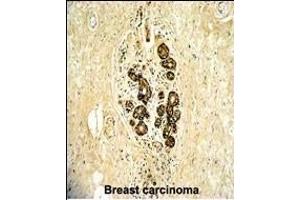 Formalin-fixed and paraffin-embedded human breast carcinoma with ErbB3 Antibody (N-term), which was peroxidase-conjugated to the secondary antibody, followed by DAB staining. (ERBB3 Antikörper  (N-Term))