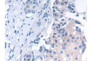 Detection of NCAD in Human Breast cancer Tissue using Polyclonal Antibody to N-cadherin (NCAD) (N-Cadherin Antikörper  (AA 685-784))