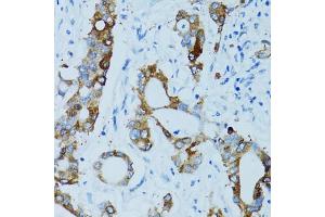 Immunohistochemistry of paraffin-embedded human colon carcinoma using CTSE antibody (ABIN5971444) at dilution of 1/100 (40x lens). (Cathepsin E Antikörper)