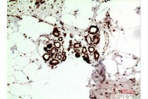 Immunohistochemistry (IHC) analysis of paraffin-embedded Human Breast Cancer, antibody was diluted at 1:100. (HSP70 Antikörper  (Ser102))