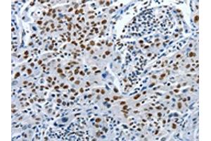 The image on the left is immunohistochemistry of paraffin-embedded Human lung cancer tissue using ABIN7191895(PIWIL3 Antibody) at dilution 1/20, on the right is treated with synthetic peptide. (PIWIL3 Antikörper)
