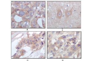 Immunohistochemical analysis of paraffin-embedded human ovary carcinoma (A), normal cerebrum tissues (B), breast infiltrating carcinoma (C) and breast infiltrating carcinoma (D), showing cytoplasmic localization using STYK1/NOK antibody with DAB staining. (STYK1 Antikörper)