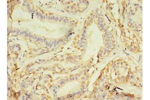 Immunohistochemistry of paraffin-embedded human breast cancer using ABIN7161747 at dilution of 1:100 (NAIF1 Antikörper  (AA 1-172))