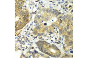 Immunohistochemistry of paraffin-embedded human gastric cancer using DPP3 antibody. (DPP3 Antikörper)
