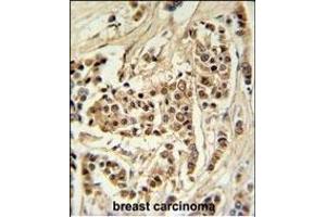 TTL Antibody (C-term) (ABIN651357 and ABIN2840199) IHC analysis in formalin fixed and raffin embedded human breast carcinoma followed by peroxidase conjugation of the secondary antibody and DAB staining. (TTPAL Antikörper  (C-Term))