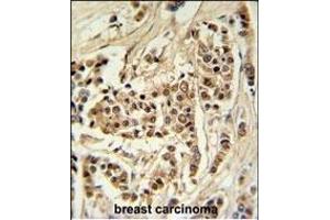 TTL Antibody (C-term) (ABIN651357 and ABIN2840199) IHC analysis in formalin fixed and raffin embedded human breast carcinoma followed by peroxidase conjugation of the secondary antibody and DAB staining.