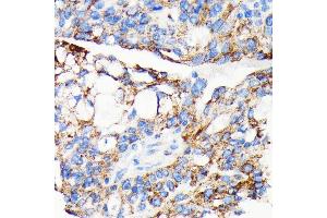 Immunohistochemistry of paraffin-embedded human oophoroma using AIF antibody (ABIN7265648) at dilution of 1:100 (40x lens). (AIF Antikörper)