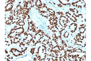 Formalin-fixed, paraffin-embedded human Prostate Carcinoma stained with FOXA1 Monoclonal Antibody (FOXA1/1518). (FOXA1 Antikörper  (AA 372-472))