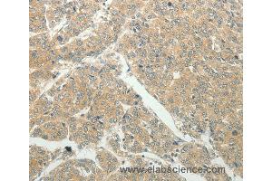 Immunohistochemistry of Human liver cancer using SLC8A3 Polyclonal Antibody at dilution of 1:50