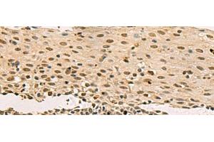 Immunohistochemistry of paraffin-embedded Human cervical cancer tissue using LRIF1 Polyclonal Antibody at dilution of 1:70(x200) (C1orf103 Antikörper)