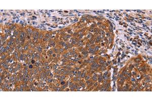 Immunohistochemistry of paraffin-embedded Human cervical cancer tissue using FBXW7 Polyclonal Antibody at dilution 1:40 (FBXW7 Antikörper)