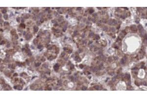 ABIN6273904 at 1/100 staining Human liver cancer tissue by IHC-P. (LPAR5 Antikörper  (Internal Region))