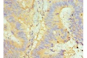Immunohistochemistry of paraffin-embedded human colon cancer using ABIN7154050 at dilution of 1:100 (Glutaredoxin 2 Antikörper  (AA 1-124))