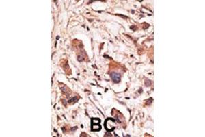 Formalin-fixed and paraffin-embedded human cancer tissue reacted with the primary antibody, which was peroxidase-conjugated to the secondary antibody, followed by DAB staining. (MAGED1 Antikörper  (AA 426-456))