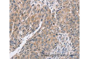 Immunohistochemistry of Human lung cancer using PPP1CC Polyclonal Antibody at dilution of 1:40 (PPP1CC Antikörper)