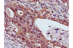 Immunohistochemistry of paraffin-embedded human colon cancer using ABIN7172051 at dilution of 1:100 (THO Complex 3 Antikörper  (AA 2-351))
