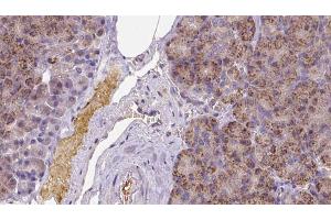 ABIN6273258 at 1/100 staining Human pancreas cancer tissue by IHC-P. (KCTD12 Antikörper  (Internal Region))