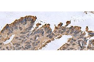 Immunohistochemistry of paraffin-embedded Human colorectal cancer tissue using DCTPP1 Polyclonal Antibody at dilution of 1:85(x200) (DCTPP1 Antikörper)