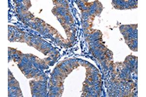 The image on the left is immunohistochemistry of paraffin-embedded Human cervical cancer tissue using ABIN7193124(Gjc3 Antibody) at dilution 1/10, on the right is treated with synthetic peptide. (GJC3 Antikörper)