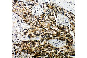 Anti-Hamartin antibody, IHC(P) IHC(P): Human Mammary Cancer Tissue