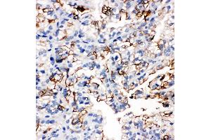 Anti-Aquaporin 1 antibody, IHC(P) IHC(P): Human Kidney Cancer Tissue