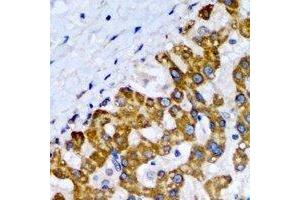 Immunohistochemical analysis of SCP2 staining in human liver cancer formalin fixed paraffin embedded tissue section.
