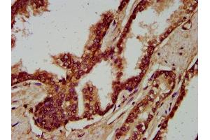 IHC image of ABIN7166221 diluted at 1:200 and staining in paraffin-embedded human prostate cancer performed on a Leica BondTM system. (IGSF9 Antikörper  (AA 132-298))