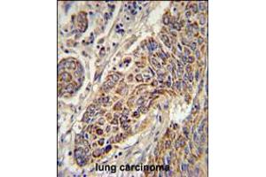 CYC1 Antibody immunohistochemistry analysis in formalin fixed and paraffin embedded human lung carcinoma followed by peroxidase conjugation of the secondary antibody and DAB staining. (Cytochrome C1 Antikörper  (C-Term))
