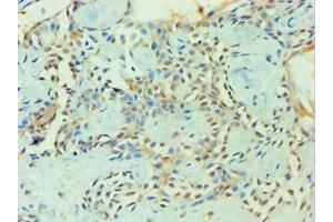 Immunohistochemistry of paraffin-embedded human breast cancer using ABIN7176252 at dilution of 1:100