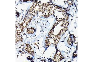 Immunohistochemistry of paraffin-embedded human breast cancer using SUFU Rabbit pAb (ABIN6133029, ABIN6148692, ABIN6148694 and ABIN6217424) at dilution of 1:100 (40x lens). (SUFUH Antikörper  (AA 325-484))