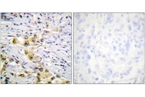 Immunohistochemistry analysis of paraffin-embedded human lung carcinoma tissue, using IGF2R (Ab-2484) Antibody. (IGF2R Antikörper  (AA 2441-2490))