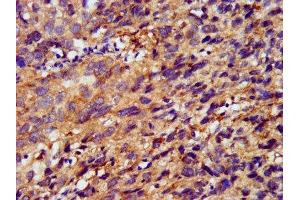 IHC image of ABIN7159577 diluted at 1:400 and staining in paraffin-embedded human ovarian cancer performed on a Leica BondTM system. (METAP1 Antikörper  (AA 54-125))