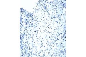 VHL Immunohistochemical staining on human renal cell carcinoma. (VHL Antikörper  (AA 1-213))