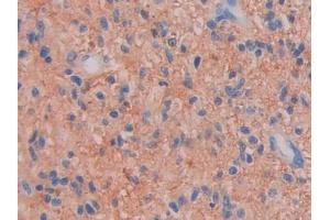 DAB staining on IHC-P; Samples: Human Glioma Tissue (Factor VII Antikörper  (AA 334-452))